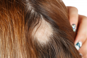 view of bald spot in woman's head; alopecia